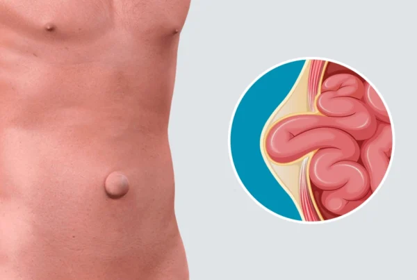 ¿Por qué se forman las hernias? Causas y factores de riesgo - Hernia Especialistas de El Salvador