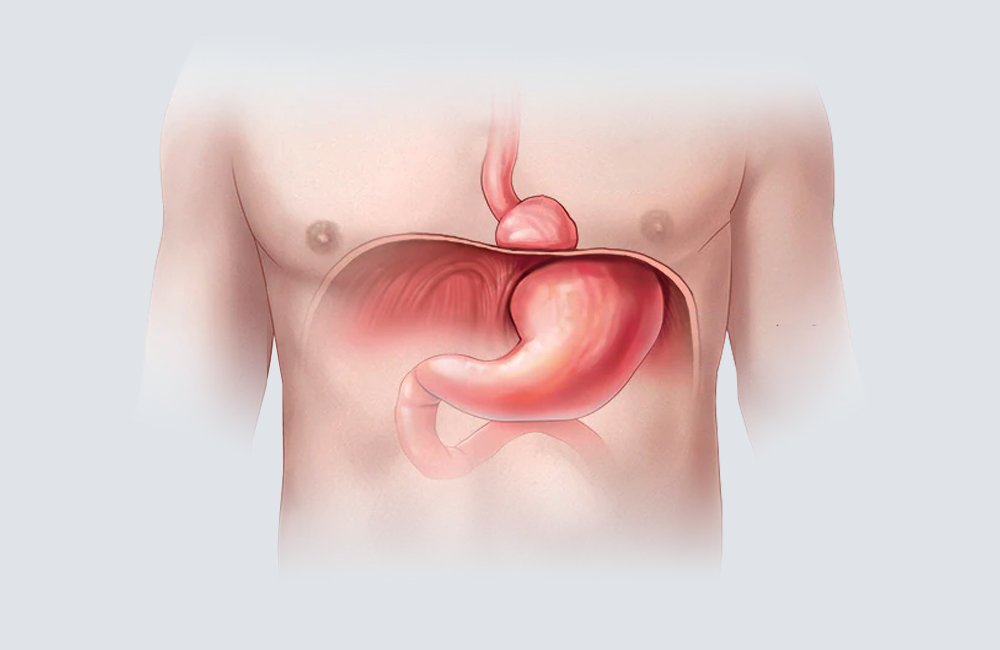 ¿Qué es la hernia de hiato? Causas, síntomas y tratamiento
