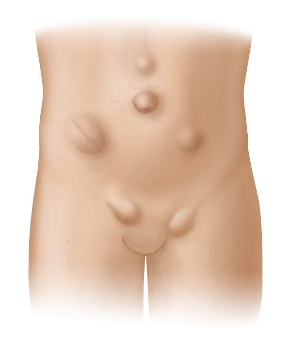 Hernia Especialistas de El Salvador